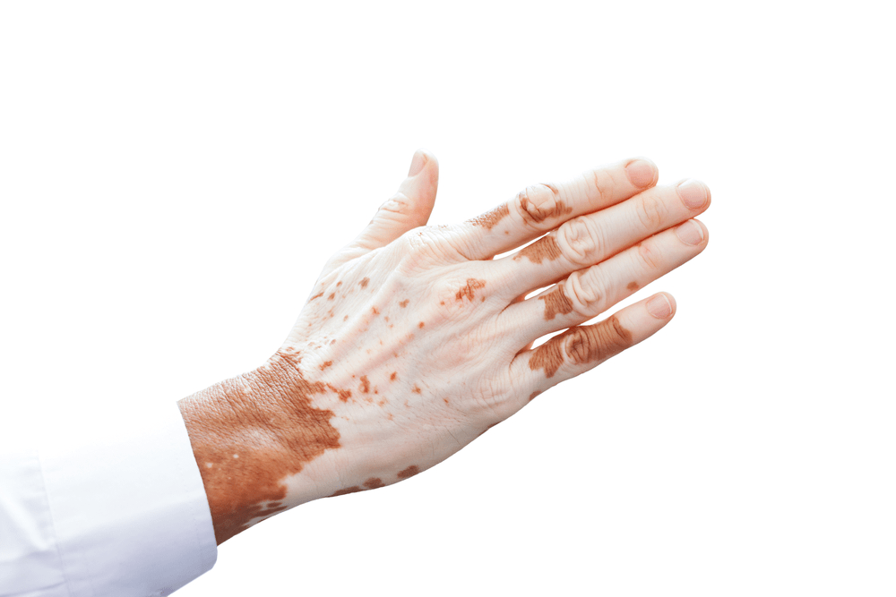 vitiligo causes